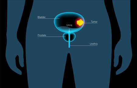 Bladder cancer stagesのイラスト素材