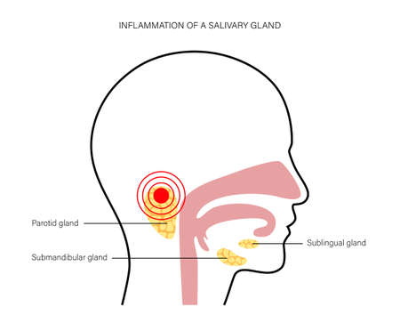 Inflammation of a salivary glands in human mouth. Parotid, submandibular, and sublingual gland. Produce of saliva through a system of ducts. Xerostomia oral disease. Medical flat vector illustration.のイラスト素材