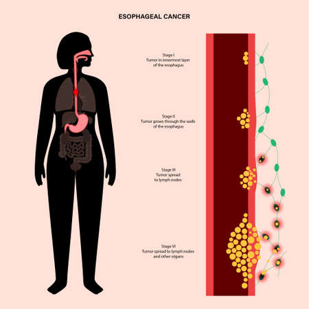 esophageal cancer stagesのイラスト素材