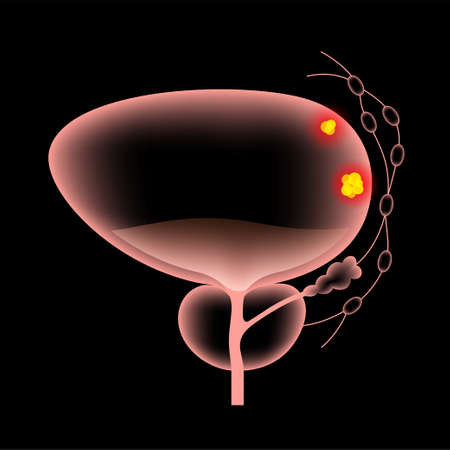 Bladder cancer stagesのイラスト素材