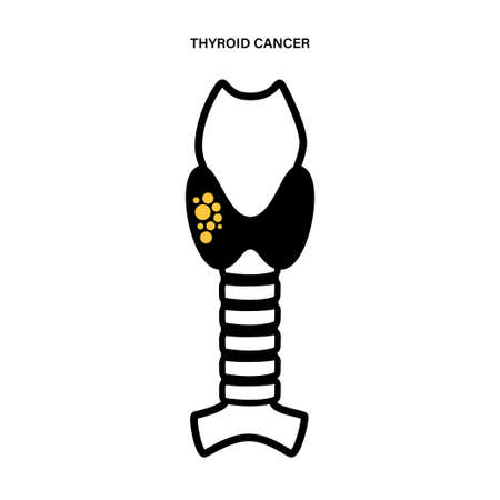 Thyroid cancer stagesのイラスト素材