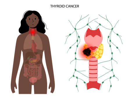 Thyroid cancer stagesのイラスト素材