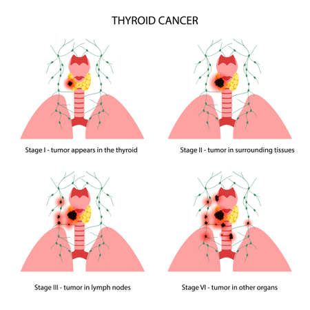 Thyroid cancer stagesのイラスト素材
