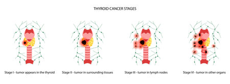 Thyroid cancer stagesのイラスト素材