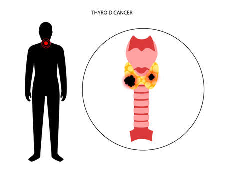 Thyroid cancer stagesのイラスト素材