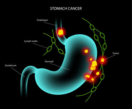 Stomach cancer anatomyのイラスト素材
