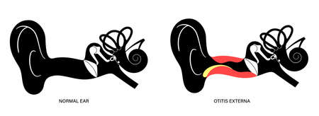 Swimmers ear otitisのイラスト素材