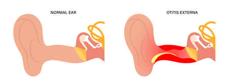 Swimmers ear otitisのイラスト素材