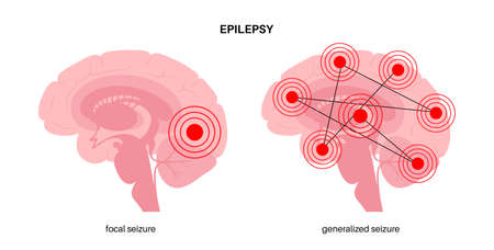 epilepsy seizure conceptのイラスト素材