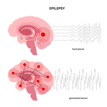 epilepsy seizure conceptのイラスト素材
