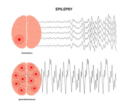 epilepsy seizure conceptのイラスト素材