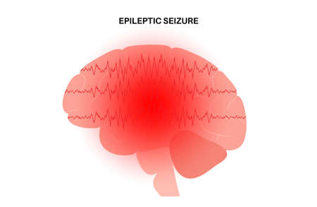 epilepsy seizure conceptのイラスト素材