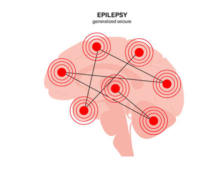 epilepsy seizure conceptのイラスト素材