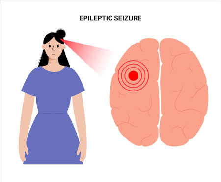 epilepsy seizure conceptのイラスト素材