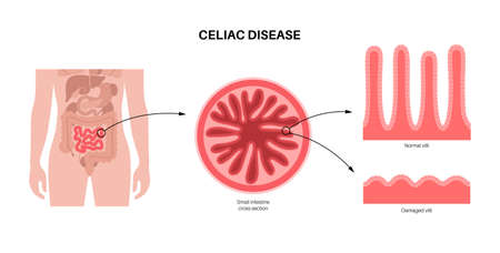 Celiac disease inflammationのイラスト素材