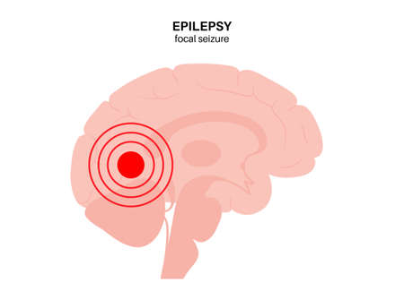 epilepsy seizure conceptのイラスト素材