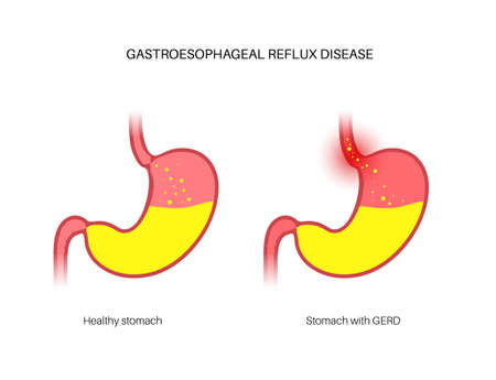 Gastroesophageal reflux diseaseのイラスト素材