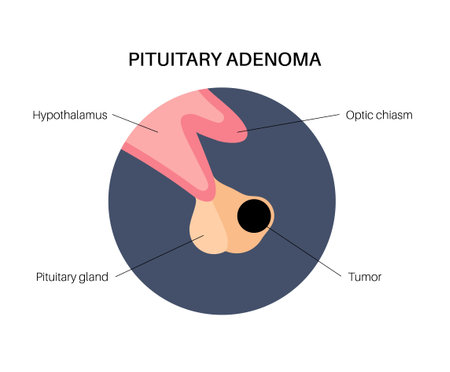 Pituitary adenoma cancerのイラスト素材