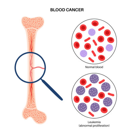 Leukemia cancer diseaseのイラスト素材