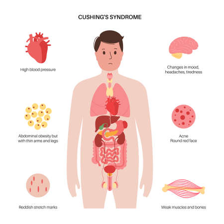 Cushing Desease posterのイラスト素材