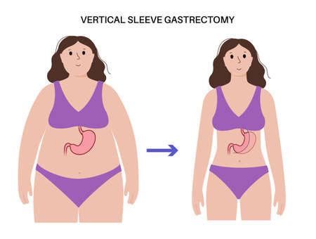 Laparoscopic sleeve gastrectomyのイラスト素材