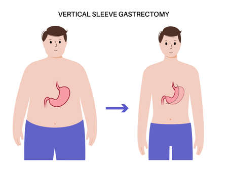 Laparoscopic sleeve gastrectomyのイラスト素材