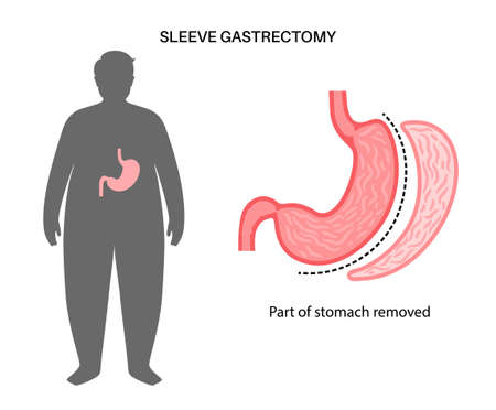 Laparoscopic sleeve gastrectomyのイラスト素材
