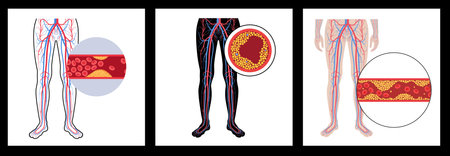 Peripheral artery diseaseのイラスト素材