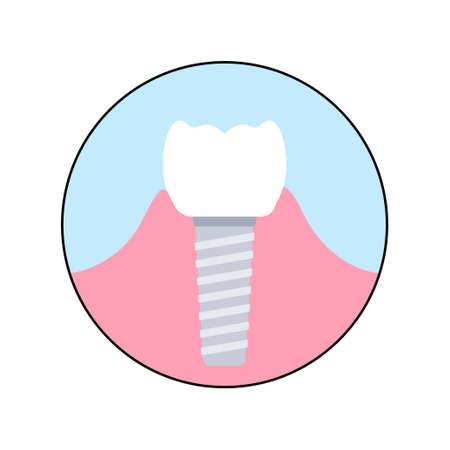Dental implant procedureのイラスト素材