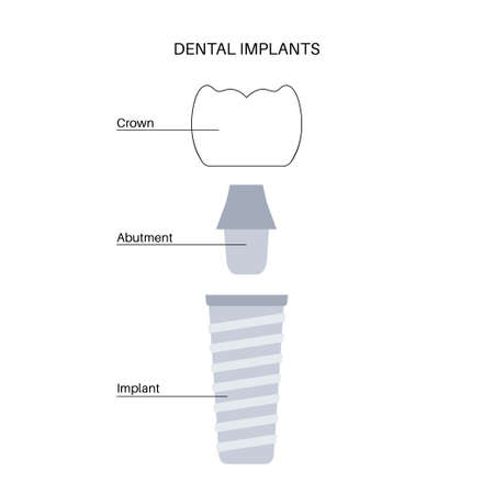 Dental implant procedureのイラスト素材