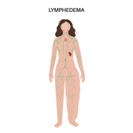 Lymphedema leg swellingのイラスト素材