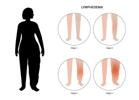 Stages of lymphedemaのイラスト素材
