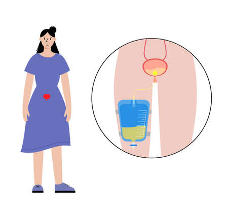 Urinary drainage bagのイラスト素材