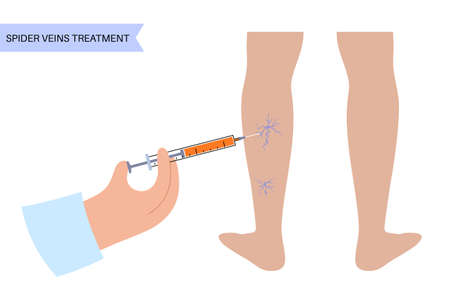 Varicose Injection procedureのイラスト素材
