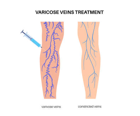Varicose Injection procedureのイラスト素材