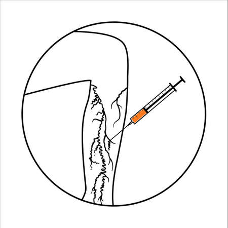 Varicose Injection procedureのイラスト素材
