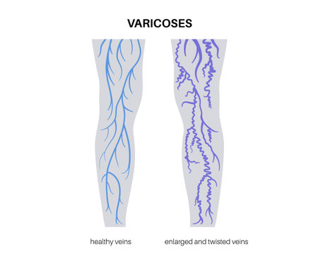 Varicose veins treatmentのイラスト素材