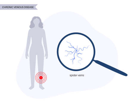 Varicose veins treatmentのイラスト素材
