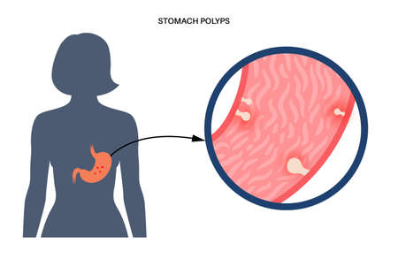 Stomach polyp diseaseのイラスト素材