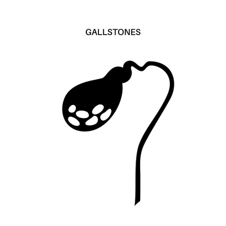gallbladder stones anatomyのイラスト素材
