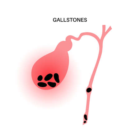 gallbladder stones anatomyのイラスト素材