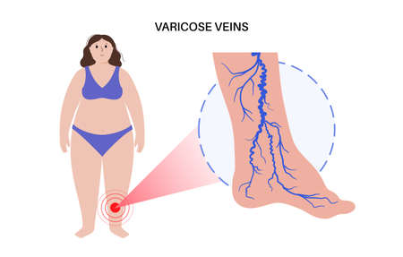 Varicose veins treatmentのイラスト素材