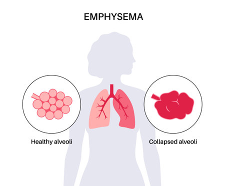 Emphysema anatomical posterのイラスト素材