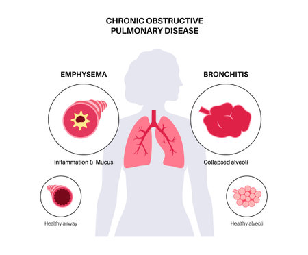 Chronic obstructive pulmonary diseaseのイラスト素材