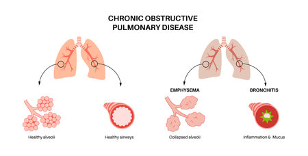 Chronic obstructive pulmonary diseaseのイラスト素材