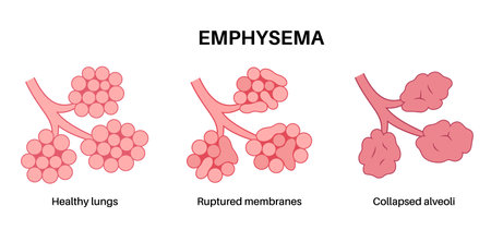 Emphysema anatomical posterのイラスト素材