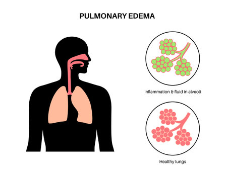 Pulmonary edema diseaseのイラスト素材