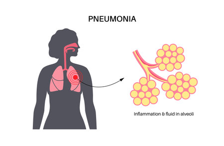 Pneumonia infection posterのイラスト素材