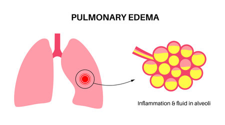 Pulmonary edema diseaseのイラスト素材