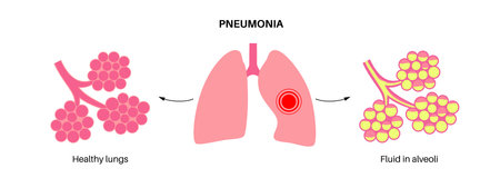 Pneumonia infection posterのイラスト素材